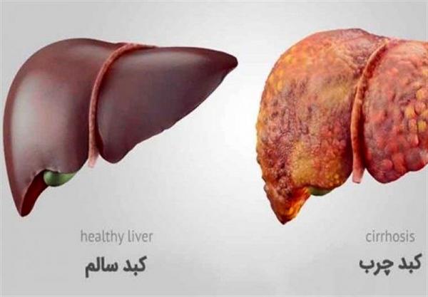 این علائم از بیماری های کبدی خبر می دهد